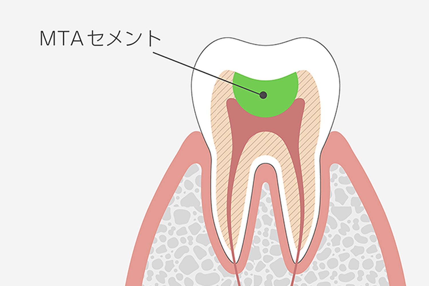 MTAセメント